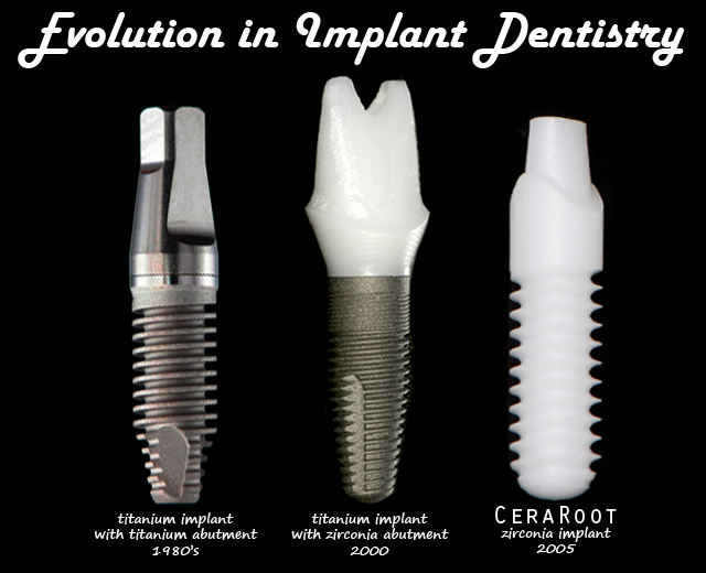 Most dental clinics in Costa Rica use Zimmer Dental Implants.